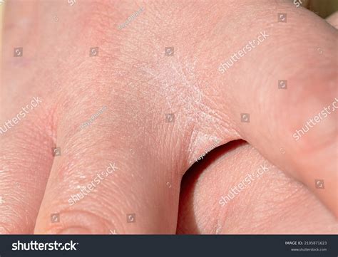 Concept Extremely Dry Dehydrated Skin Hands Stock Photo 2105871623 ...