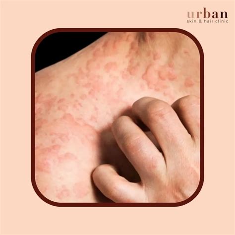 Severe Pruritus Ani Pruritus Ani | Abdominal Key