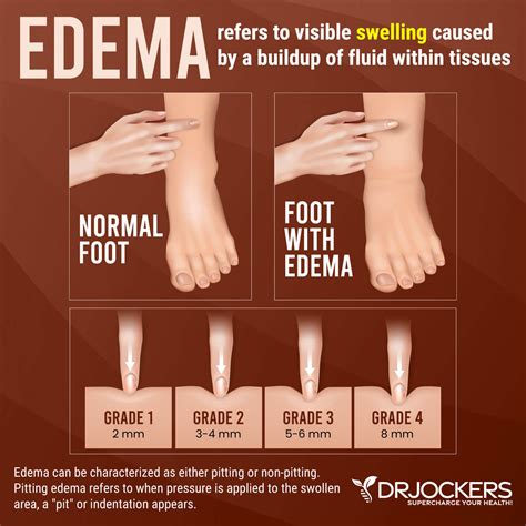 Foot Edema Causes And Treatment