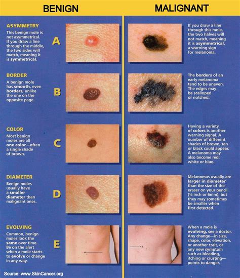 ABCDEs of Melanoma
