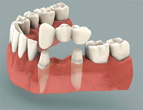 Cantilever Bridge Dental | Dental Bridges