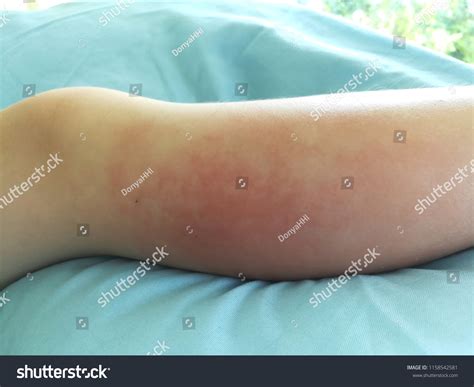 La celulitis de la pierna derecha Foto de stock 1158542581 | Shutterstock