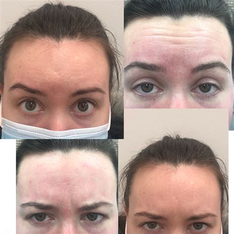 Crows Feet Botox | MedVSPA