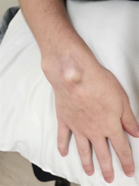 Had a ganglion cyst popped yesterday : r/MakeMeSuffer