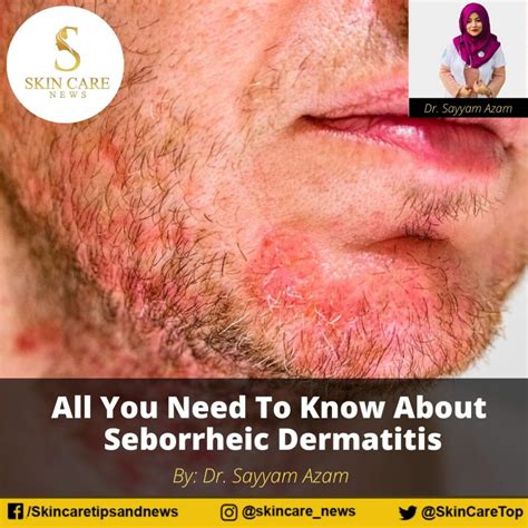 All You Need To Know About Seborrheic Dermatitis