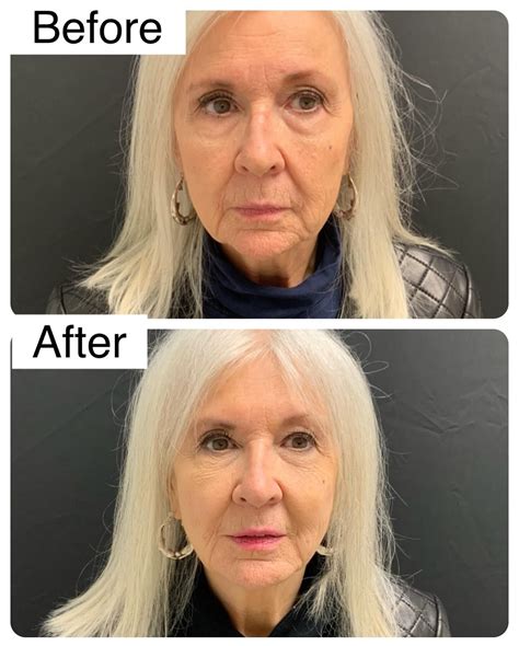 Joyce meyer s plastic surgery journey before after – Artofit