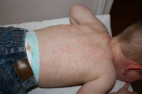 Diaper Rash And Diarrhea Toddler at James Tarvin blog