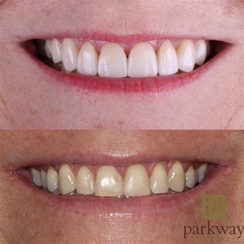 Cosmetic Dental Makeover Treatment at Michael Berryhill blog
