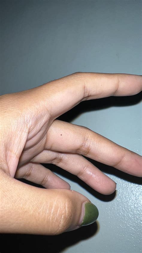 New mole appeared on my finger like maybe almost 2 mos ago. Could it possibly be melanoma? : r ...