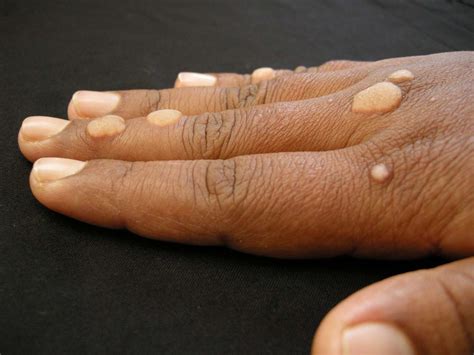 Warts On Finger