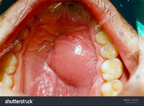 Abscess In Mouth Roof