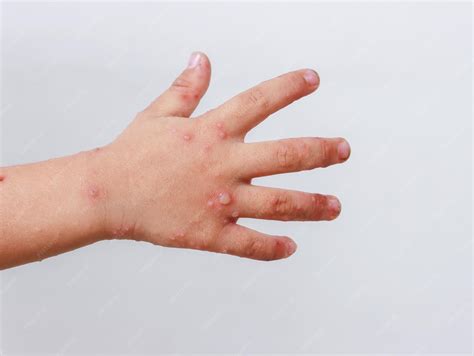 Premium Photo | Red rash on baby hands hand-foot-and-mouth disease hfmd ...