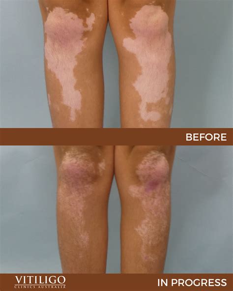 Light Therapy For Vitiligo Before And After at Bonnie Call blog