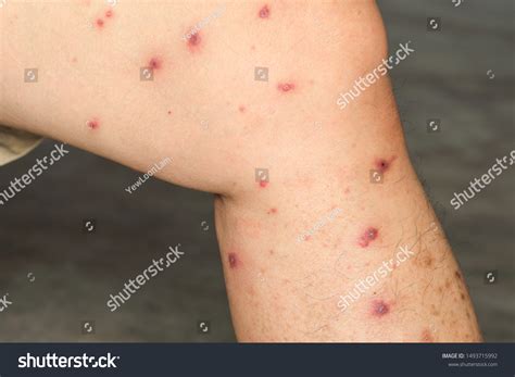 Skinbumpslumpsblisters Caused By Insect Sandfly Bites Stock Photo ...