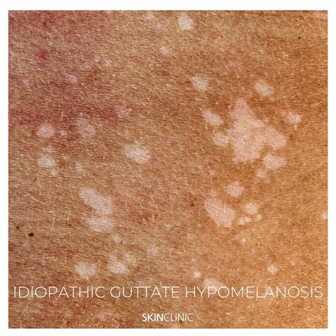 Idiopathic Guttate Hypomelanosis