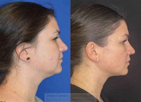 Chin (Submental) Liposuction in Boston – Plastic Surgery | Boston | Dr. Christopher Davidson