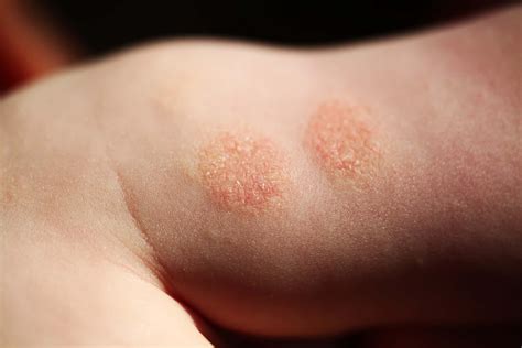 Treating Eczema - DermCare Scannon Dermatology
