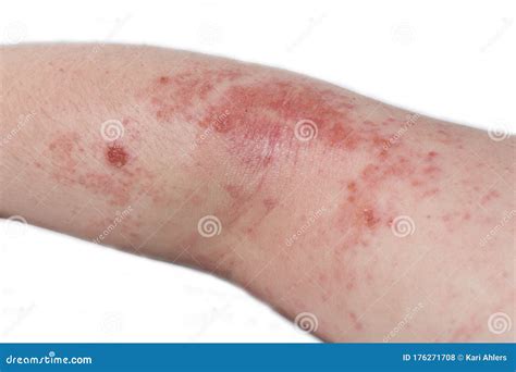 How To Treat Itchy Rash On Elbow at Georgia Challis blog