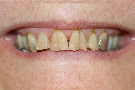 Broken and Chipped teeth fixed with Porcelain Crowns