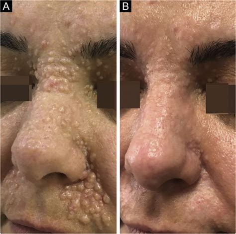 Laser-assisted delivery of imiquimod in Brooke-Spiegler syndrome | Anais Brasileiros de Dermatologia