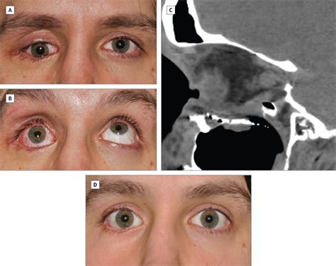 What Is Orbital Floor Fracture Repair at Carmella Tabor blog