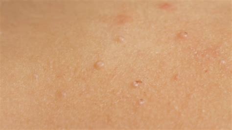 7 common summer skin rashes in children | Virtuwell