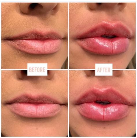 Lip Enhancement With Botox at Harvey Horton blog