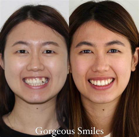 Crooked Teeth With Braces Before And After