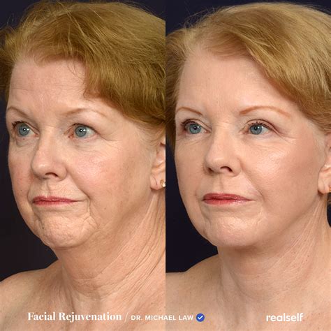 Lower Facelift vs. Neck Lift: What’s the Difference? | Anti aging skin products, Anti aging skin ...