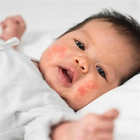 Dairy Intolerance Rash Baby at Maureen Baker blog