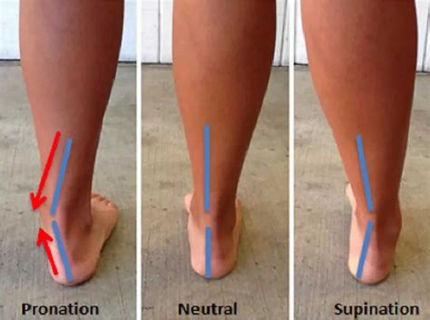 How To Fix Overpronation Of Foot