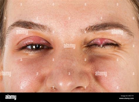 Young female suffering from chalazion - upper eyelid inflammation ...