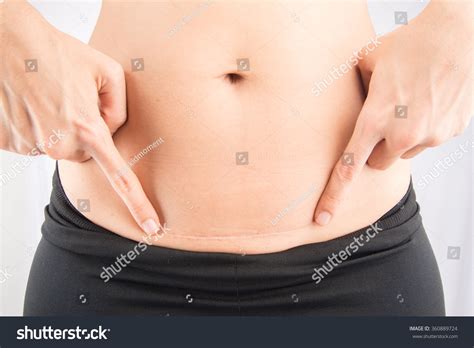 566 Scar C Section Images, Stock Photos & Vectors | Shutterstock