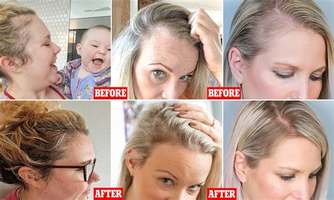 Child Hair Thinning At Front at Spencer Ebert blog