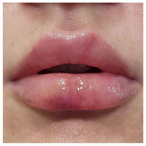Lip Filler Swelling Timeline: How Long Will It Last?