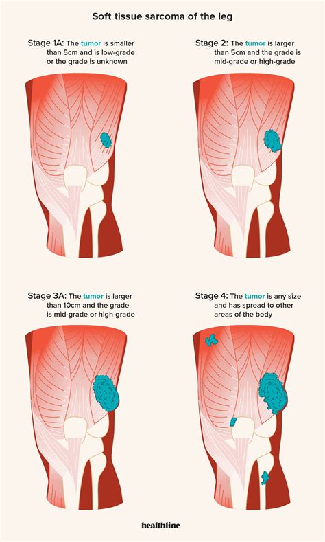 Can You Get A Cancer Lump On Your Inner Thigh - Infoupdate.org