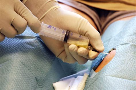 What Is A Lumbar Puncture Baby at Kristina Hertz blog