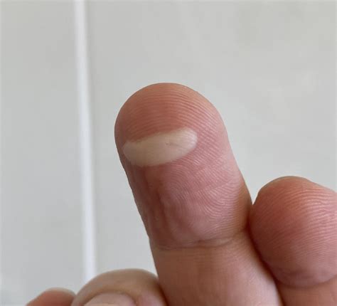 Burn blister on my finger looks like an Among Us character : r/mildlyinteresting