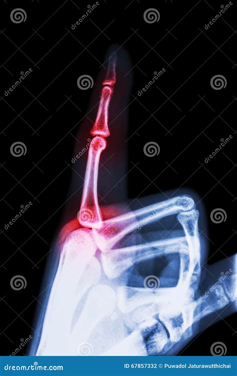 Rheumatoid Arthritis , Gouty Arthritis Stock Photo - Image of blue, phalange: 67857332