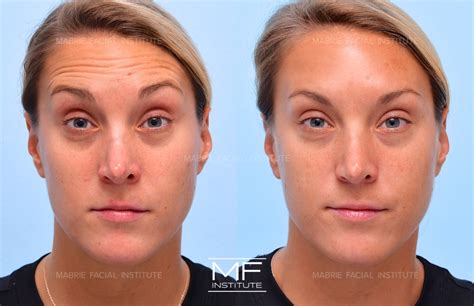 Forehead Wrinkles & Frown Lines Before and After Pictures Case 687 | San Francisco, CA | Mabrie ...