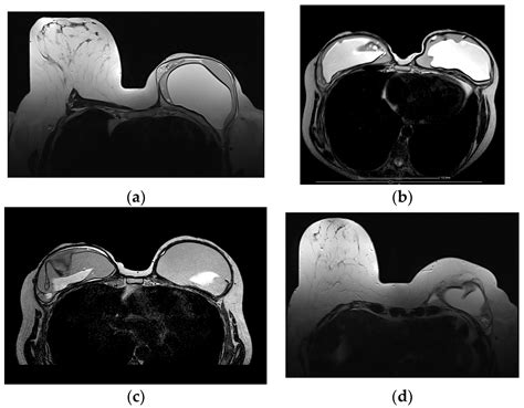 Imaging of the Reconstructed Breast