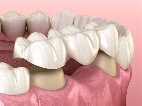 9 Things to Know About Dental Bridges