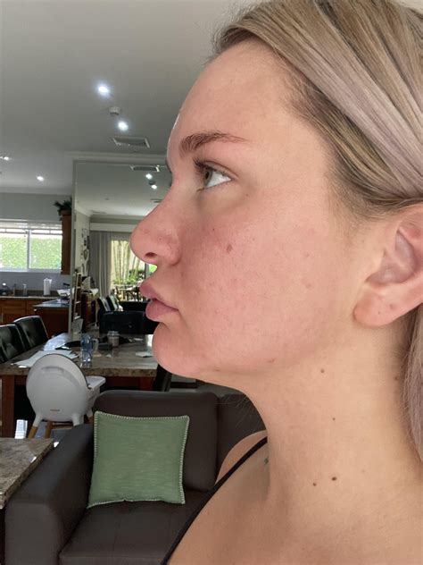 My Top Lip Sticks Out