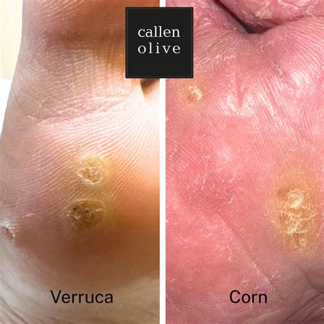 How to Tell the Difference Between a Verruca and a Corn