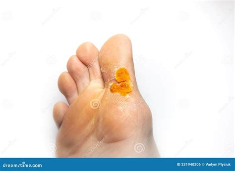Contagious Skin Illness on Foot. Medical Treatment Photo..Close Up Photo of Plantar Wart on Man ...