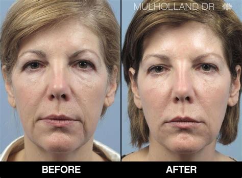 Glow & Know: Navigating CO2 Fractional Laser Side Effects Laser Hair Removal Guide