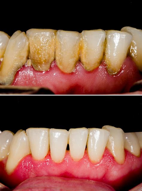 Periodontal Disease (Gum Disease) - Tuxedo Dental Group