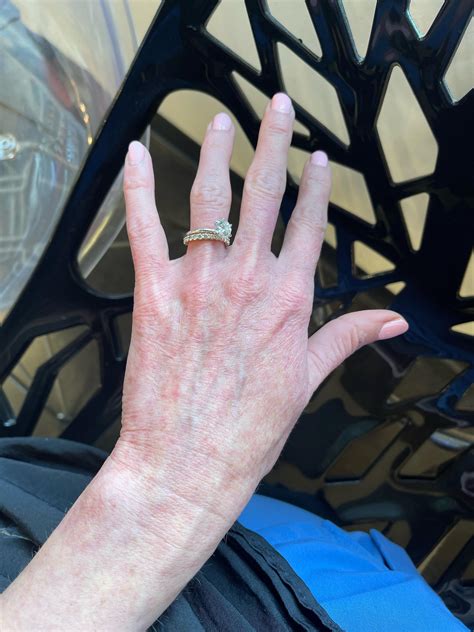 30 year old Chronic hand eczema and dry skin since childhood. tried topical steroids and ...