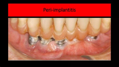 Peri-implant Diseases Classification, Cases Definition and Treatment.pdf