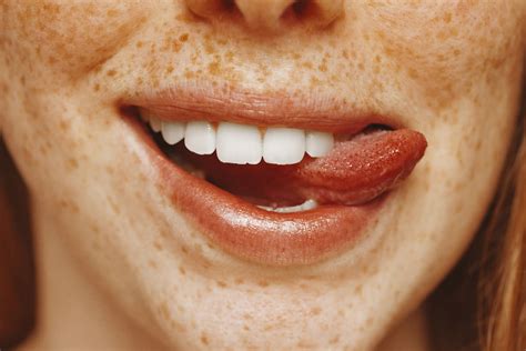 Candidiasis oral, causas y tratamientos - Clínica Dental Ana